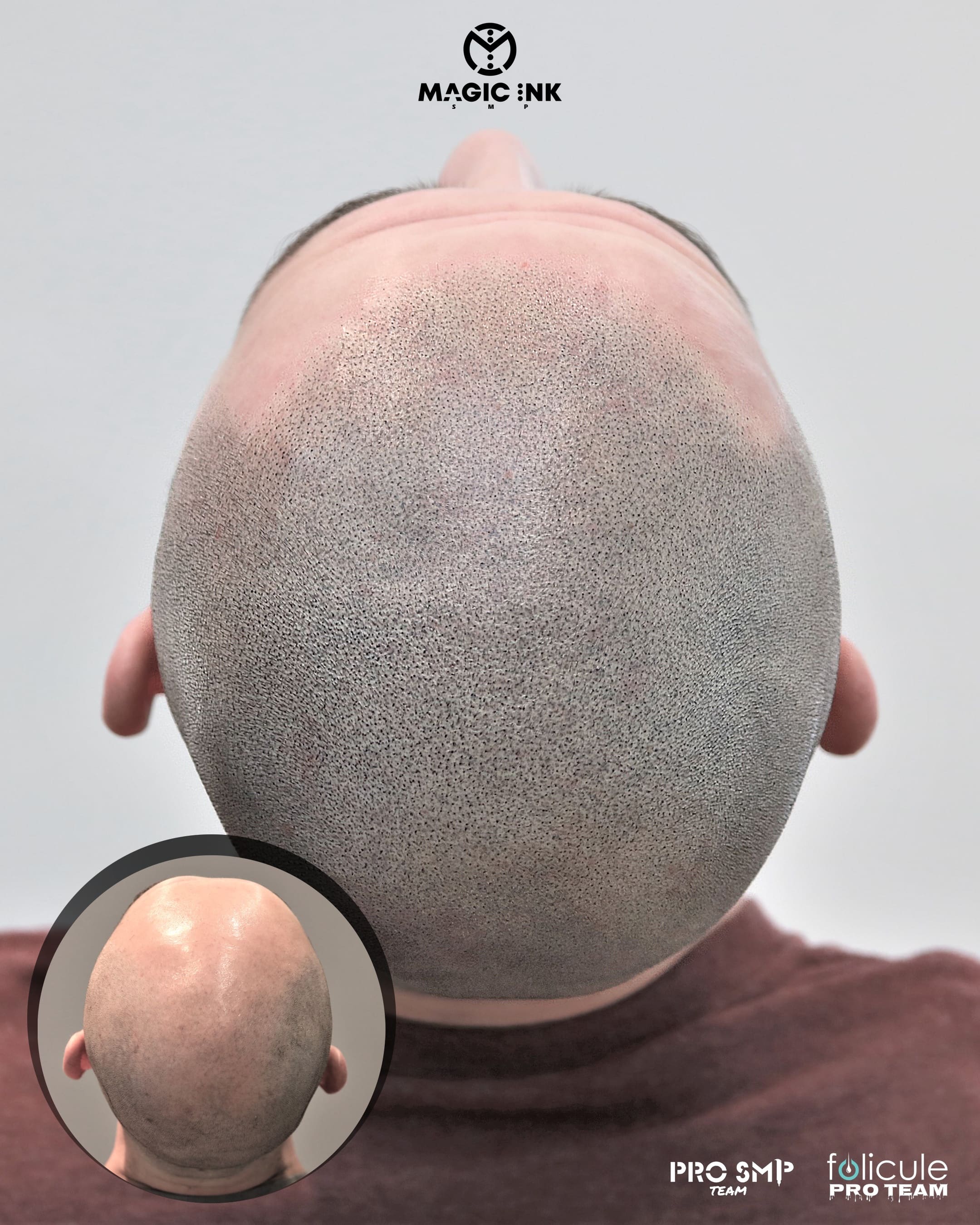 Common Problems with Hair Transplant Scars